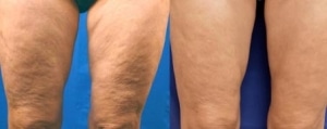 before_and_after_legs