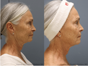 beforeandafter19